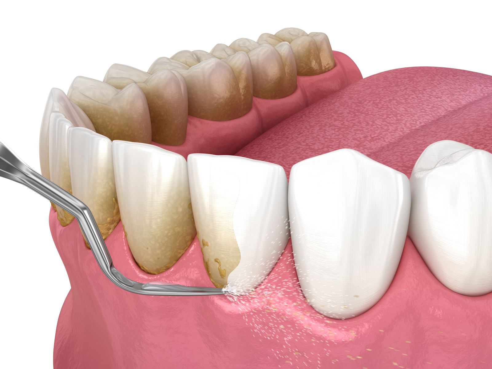 Sz jhigi ni s kezel sek fogk elt vol t s rk d Dental Fog szat